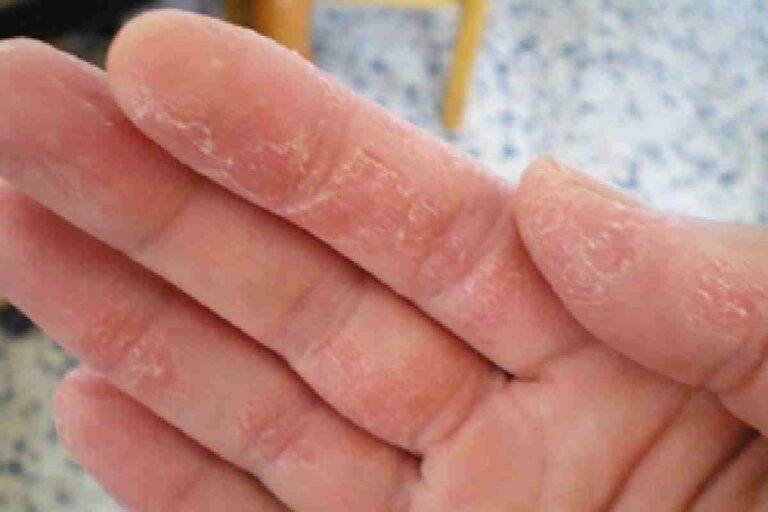 STD Skin Peeling on Hands – Methods, And More