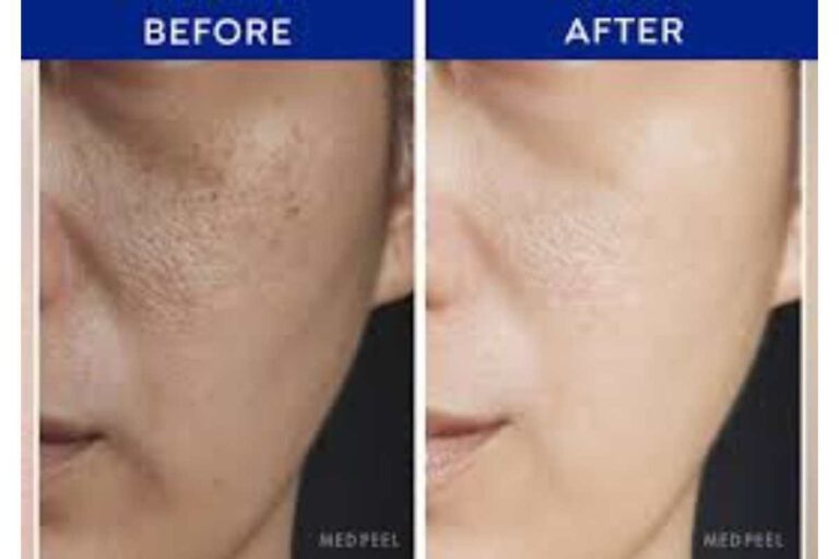 Chemical Peel Before and After: Results, Benefits, and What to Expect