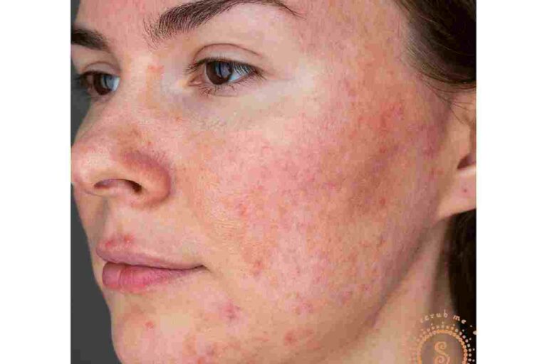 I Over-Exfoliated My Skin: Signs, Damage Control, and How to Heal Fast